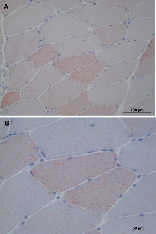 From recurrent rhabdomyolysis in a young adult to carnitine palmitoyltransferase II deficiency.