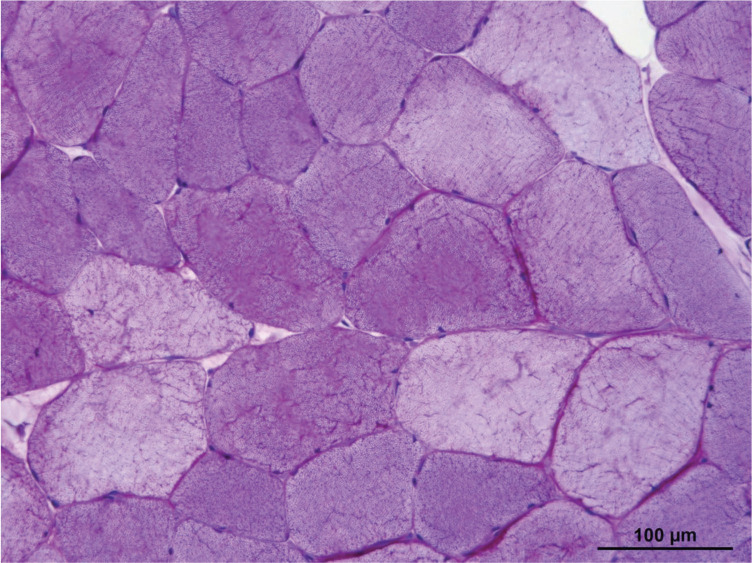 From recurrent rhabdomyolysis in a young adult to carnitine palmitoyltransferase II deficiency.