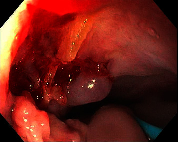 A Case of Esophago-Respiratory Fistula due to Inhalation Smoke Injury Diagnosed by Upper Endoscopy.