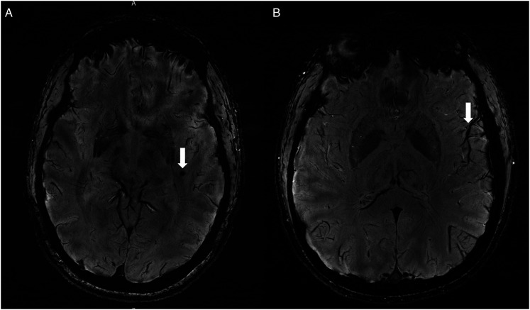 Structural MRI in Migraine: A Review of Migraine Vascular and Structural Changes in Brain Parenchyma.