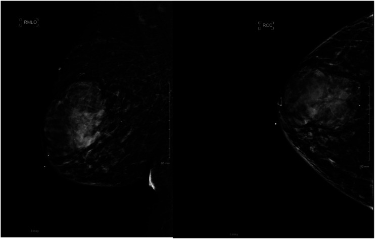 KEYNOTE-522 and male spindle cell carcinoma of the breast: A case report.