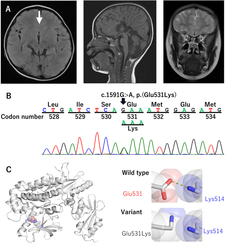 A novel missense variant of <i>FGFR1</i> in a Japanese girl with Kallmann syndrome and holoprosencephaly.