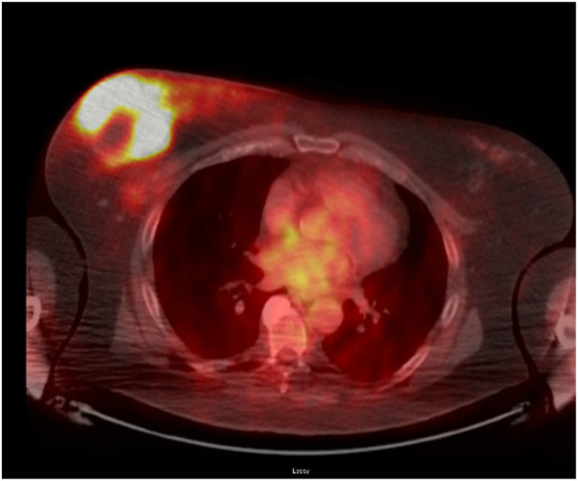 KEYNOTE-522 and male spindle cell carcinoma of the breast: A case report.