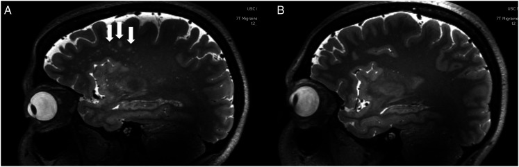 Structural MRI in Migraine: A Review of Migraine Vascular and Structural Changes in Brain Parenchyma.