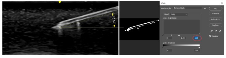 Needle visualization during ultrasound-guided puncture: image optimization.