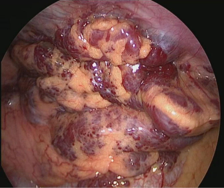 Thoracoscopic resection of a cavernous haemangioma of anterior mediastinum: case report and literature review.