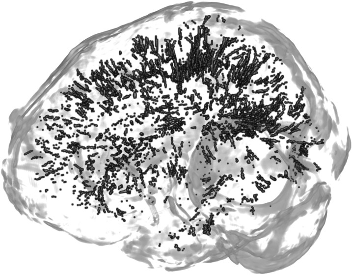 Structural MRI in Migraine: A Review of Migraine Vascular and Structural Changes in Brain Parenchyma.