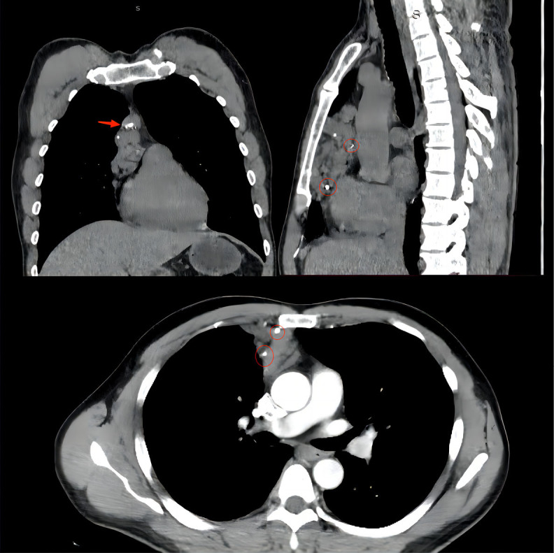 Thoracoscopic resection of a cavernous haemangioma of anterior mediastinum: case report and literature review.