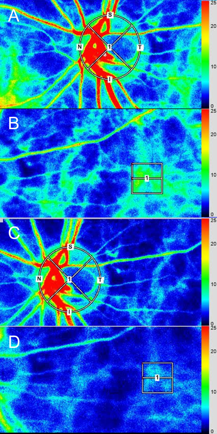 Decrease in Ocular Blood Flow Thirty Minutes After Intravitreal Injections of Brolucizumab and Aflibercept for Neovascular Age-Related Macular Degeneration.