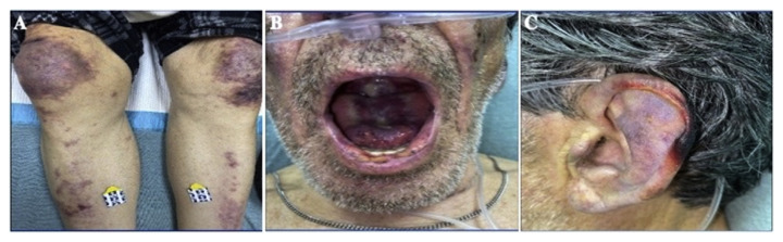 Light Chain Myeloma Precipitating Cryoglobulinemic Vasculitis.