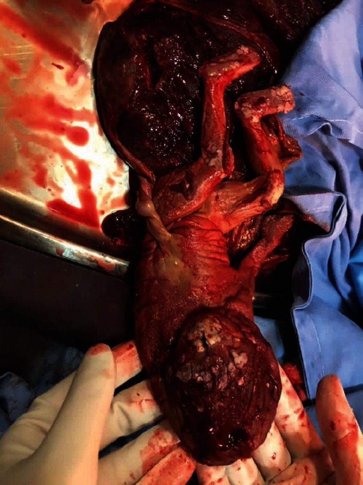 Radiofrequency Ablation and Intrauterine Transfusion in a Delayed Diagnosed Acardiac Twin Pregnancy.