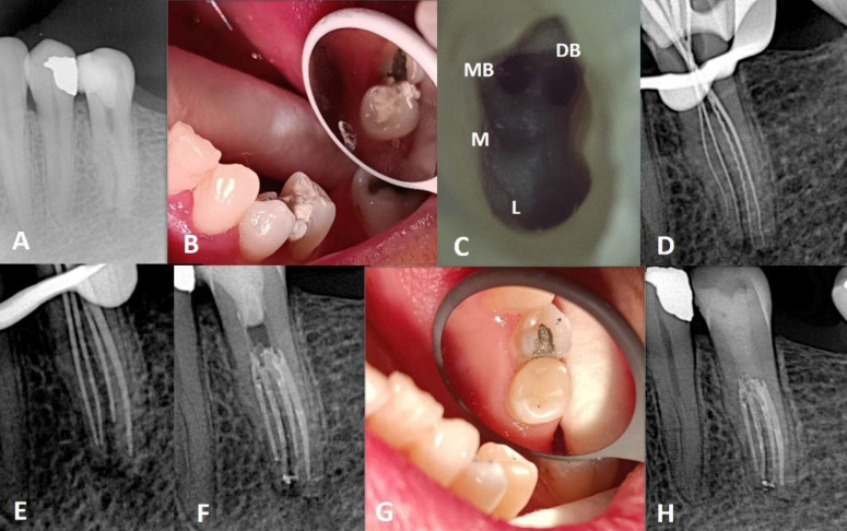 Detection and Endodontic Treatment of Unusual Anatomic Variations in Second Premolars: A Case Report.