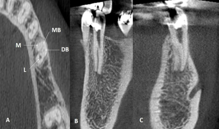 Detection and Endodontic Treatment of Unusual Anatomic Variations in Second Premolars: A Case Report.