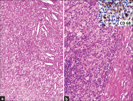 Xanthogranulomatous Change in a Leiomyoma: First Report of an Extremely Rare Variant/Degenerative Change.