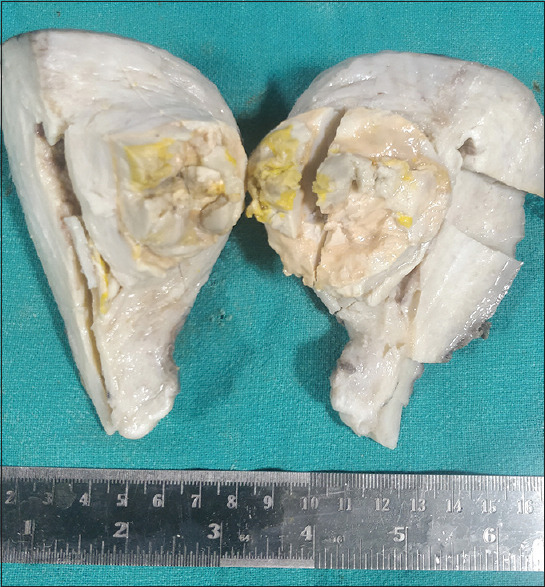 Xanthogranulomatous Change in a Leiomyoma: First Report of an Extremely Rare Variant/Degenerative Change.