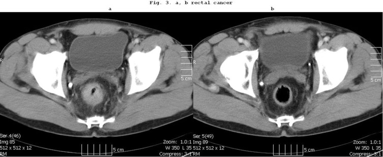 Changes in Oncological Surgical Principles Driven by Advances in Preoperative Treatments.