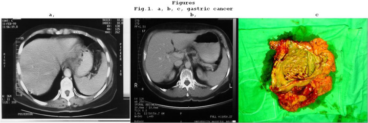 Changes in Oncological Surgical Principles Driven by Advances in Preoperative Treatments.