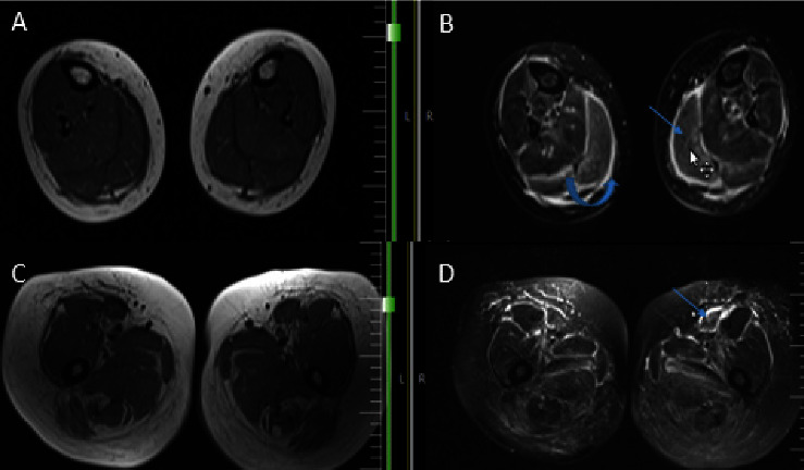 Atypical Presentation of Amyloidosis in a Female Patient with Muscle Weakness.