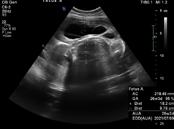 Radiofrequency Ablation and Intrauterine Transfusion in a Delayed Diagnosed Acardiac Twin Pregnancy.