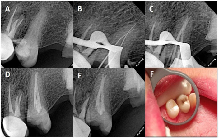 Detection and Endodontic Treatment of Unusual Anatomic Variations in Second Premolars: A Case Report.