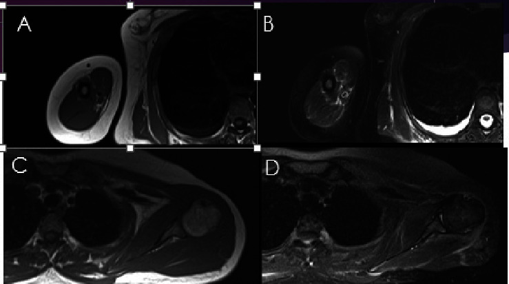 Atypical Presentation of Amyloidosis in a Female Patient with Muscle Weakness.