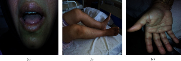 Atypical Presentation of Amyloidosis in a Female Patient with Muscle Weakness.