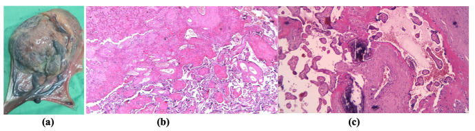 Progress Toward Reversed Uterine Diastolic Flow in the Third Trimester - An Inauspicious Sign.