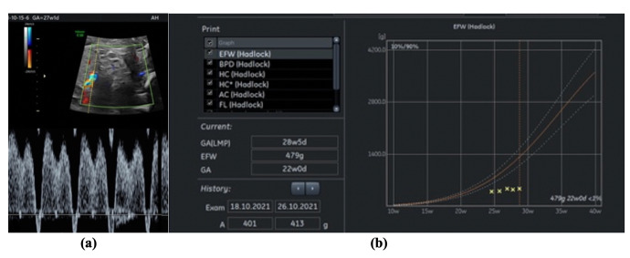 Progress Toward Reversed Uterine Diastolic Flow in the Third Trimester - An Inauspicious Sign.