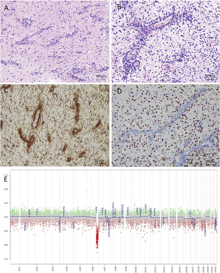 Case Report: Brainstem angiocentric glioma presenting in a toddler child-diagnostic and therapeutic challenges.