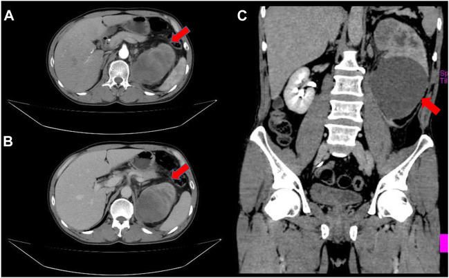 Case report: Urothelial carcinoma of the renal pelvis with trophoblastic differentiation: A rare case report and review of literature.