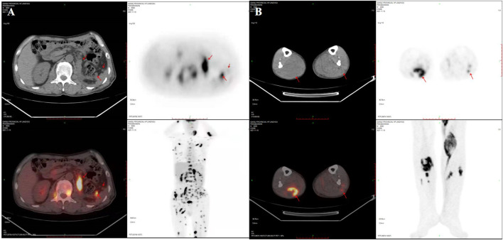 Case report: Urothelial carcinoma of the renal pelvis with trophoblastic differentiation: A rare case report and review of literature.