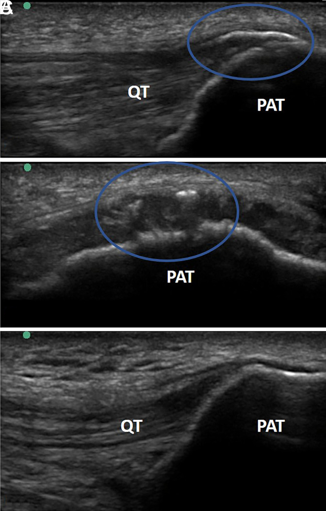 Imaging the Enthesopathy and Manipulating the Fascia: Ultrasound is the "Sous Chef".