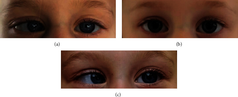 A Conservative Approach by Unilateral Maximal Single-Muscle Recession Surgery for the Treatment of Cyclic Esotropia.