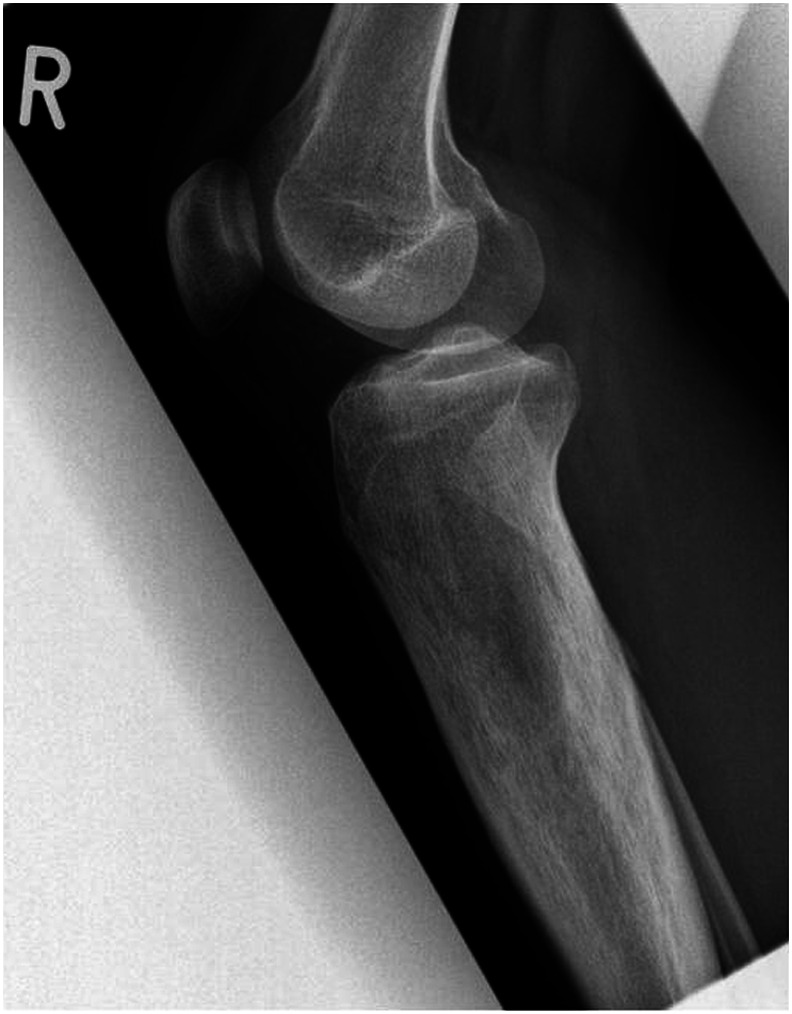 Camurati-Engelmann Disease: A Case-Based Review About an Ultrarare Bone Dysplasia.