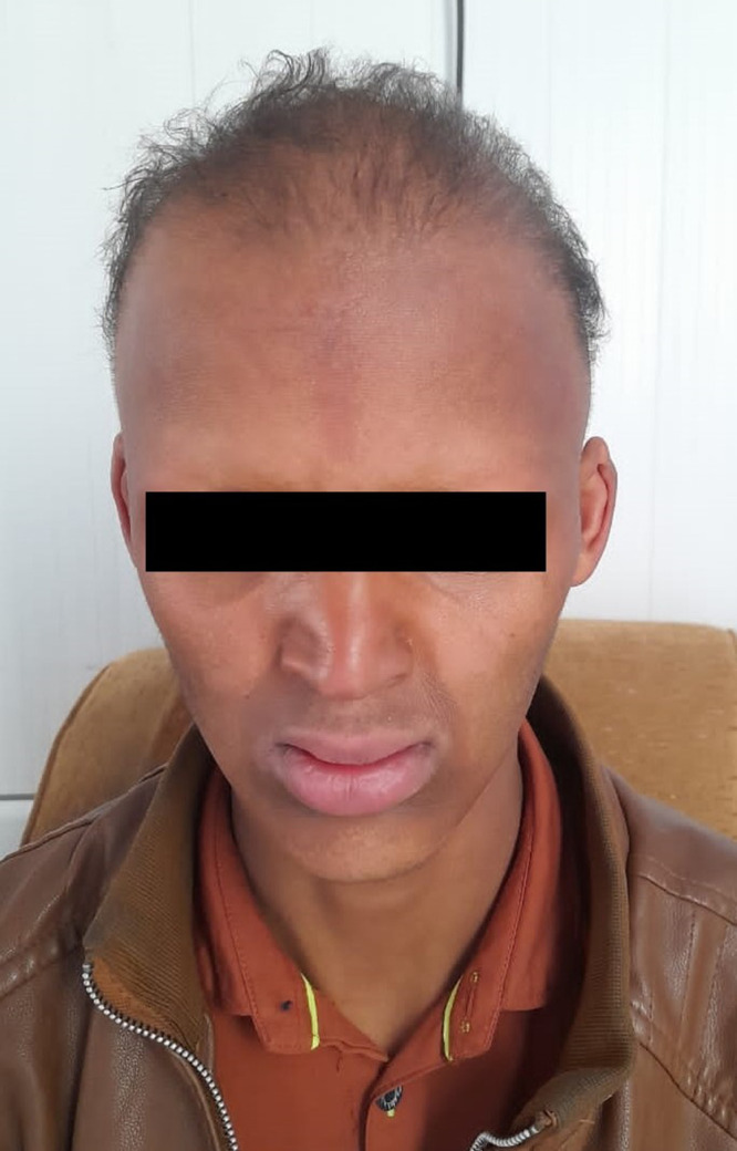 Prosthodontic Management of a Patient with Ectodermal Dysplasia: Case Report.