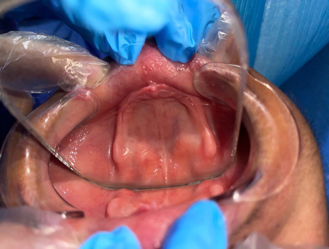 Prosthodontic Management of a Patient with Ectodermal Dysplasia: Case Report.