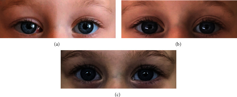 A Conservative Approach by Unilateral Maximal Single-Muscle Recession Surgery for the Treatment of Cyclic Esotropia.