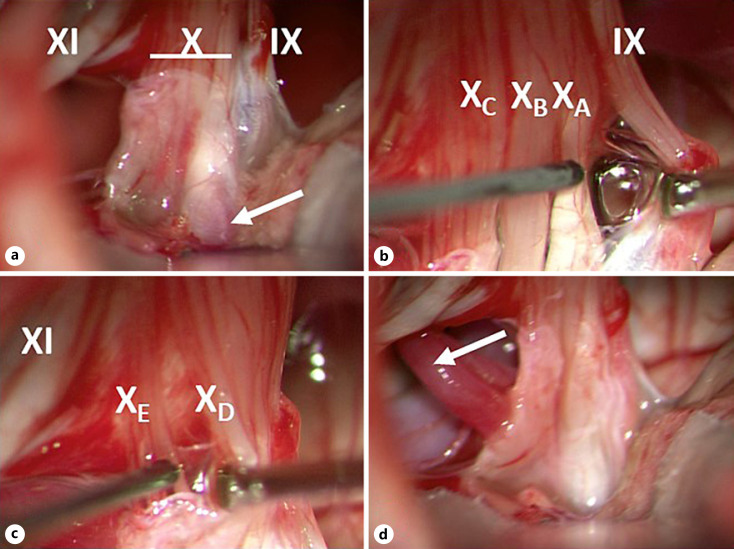 The Location of the Parasympathetic Fibres within the Vagus Nerve Rootlets: A Case Report and a Review of the Literature.