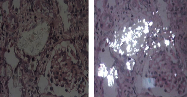 Primary Hyperoxaluria Type 1: Clinical, Paraclinical, and Evolutionary Aspects in Adults from One Nephrology Center.