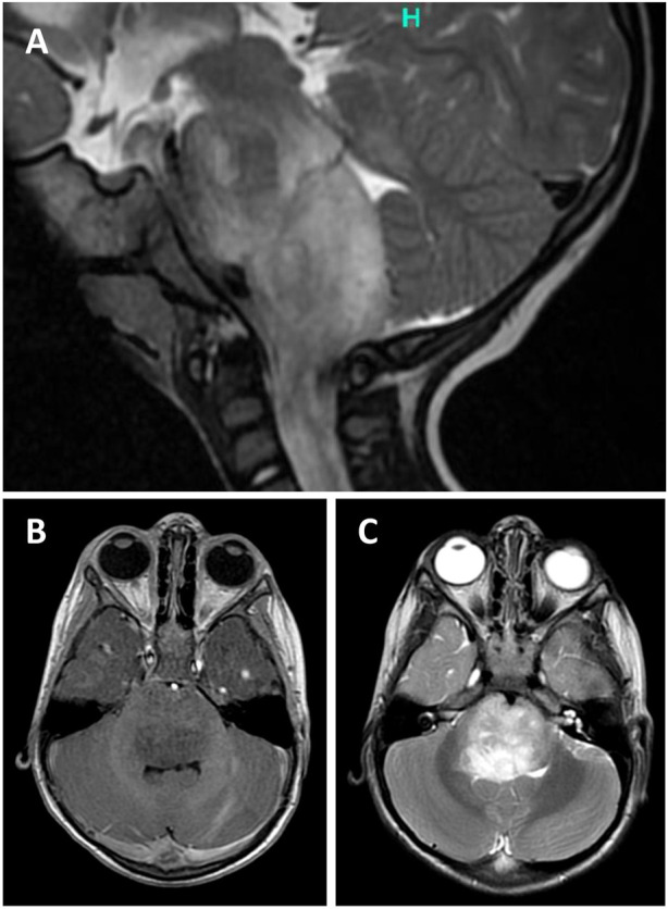 Case Report: Brainstem angiocentric glioma presenting in a toddler child-diagnostic and therapeutic challenges.