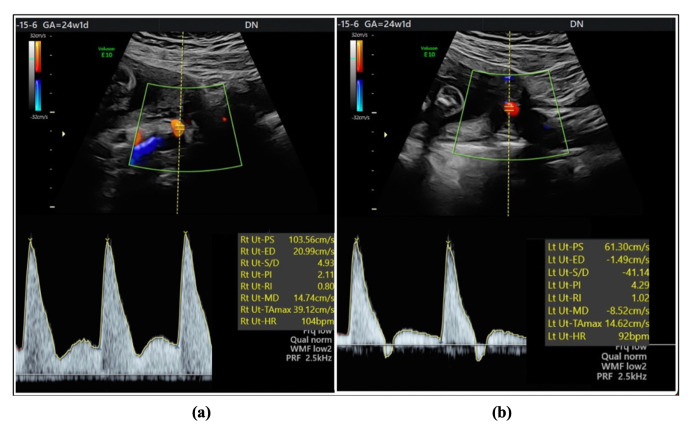 Progress Toward Reversed Uterine Diastolic Flow in the Third Trimester - An Inauspicious Sign.