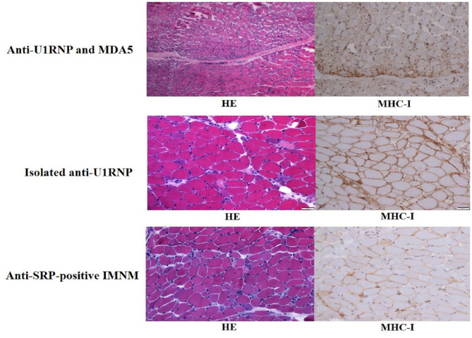 Clinical characteristics of myositis patients with isolated anti-U1 ribonucleoprotein antibody resemble immune-mediated necrotizing myopathy.