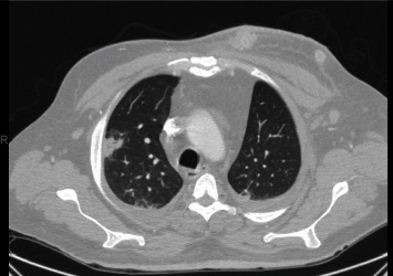 Coronary Stent Abscess in the Setting of Arteriovenous Graft Infection following COVID-19: An Autopsy Case Report.