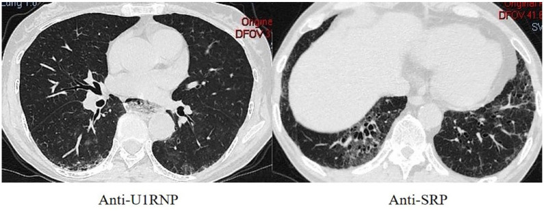 Clinical characteristics of myositis patients with isolated anti-U1 ribonucleoprotein antibody resemble immune-mediated necrotizing myopathy.