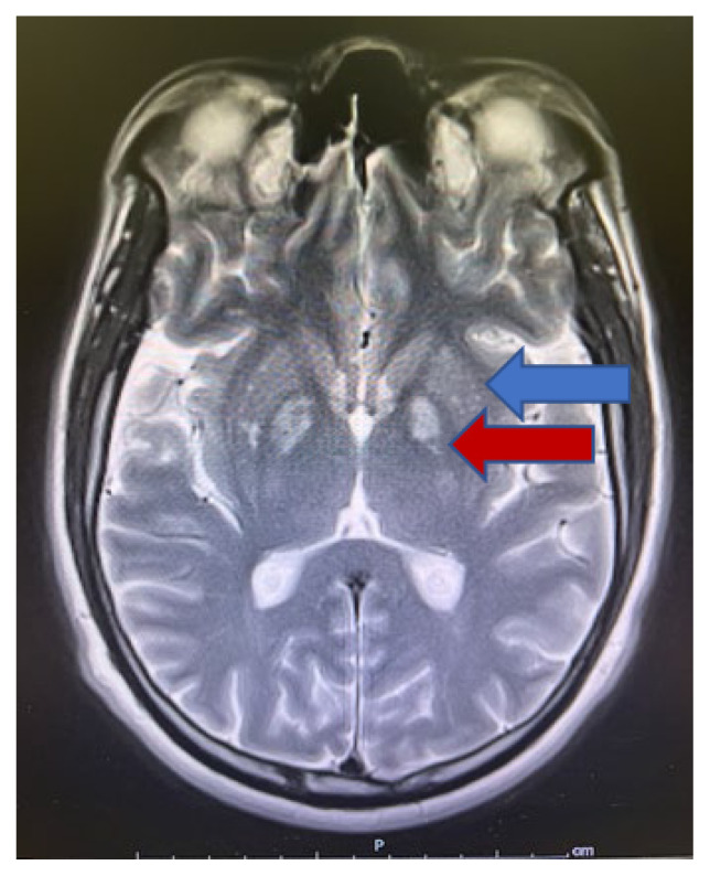 Cocaine-Induced Bilateral Basal Ganglia Ischemia Presenting with Unilateral Wrist Drop.