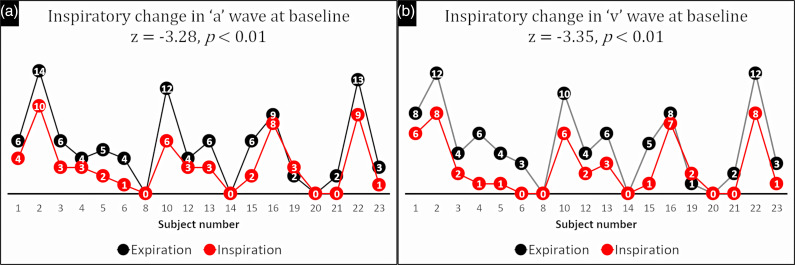 Pseudo-Kussmaul's Sign in Atrioventricular Nodal Reentry Tachycardia: A Prospective, Cohort Study.