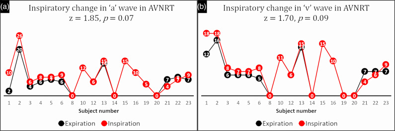 Pseudo-Kussmaul's Sign in Atrioventricular Nodal Reentry Tachycardia: A Prospective, Cohort Study.