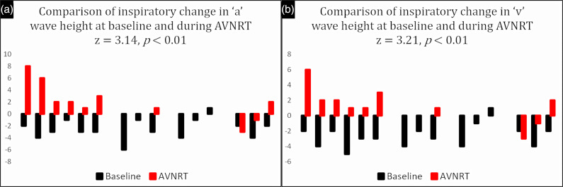 Pseudo-Kussmaul's Sign in Atrioventricular Nodal Reentry Tachycardia: A Prospective, Cohort Study.