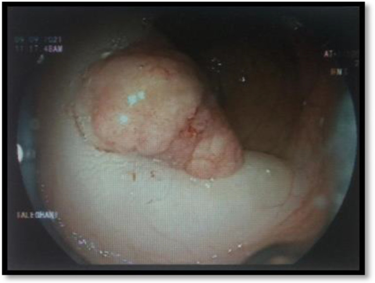 A step-by-step guide to approaching colon polyps.