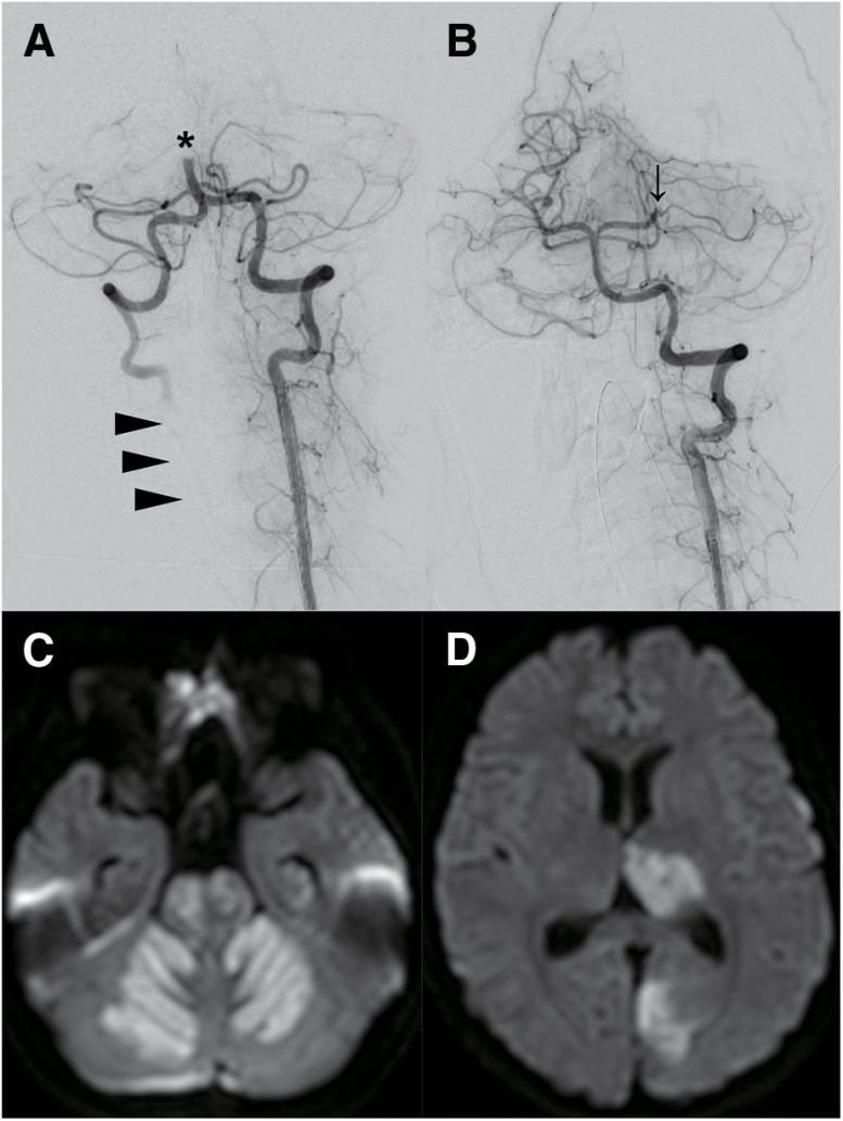 Basilar Artery Occlusion Caused by Extracranial Vertebral Artery Dissection on Its Entry into the Transverse Foramen of the C6 Vertebra: Case Report.